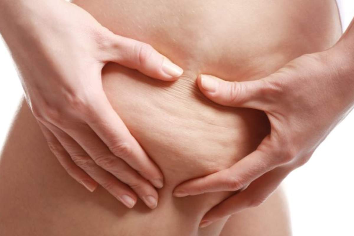 contrastare la cellulite